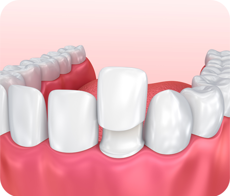 Cosmetic Dentistry - whitening porcelain veneer Dr Koutsioukis Dentist Greenville SC