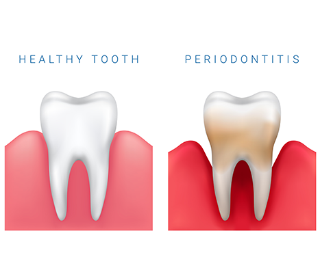 image of healthy teeth beside a tooth with periodontitis