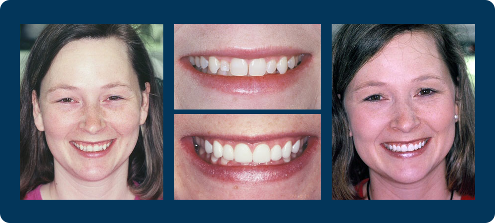 4 before and afters pictures of a female patient of Dr. Koutsioukis