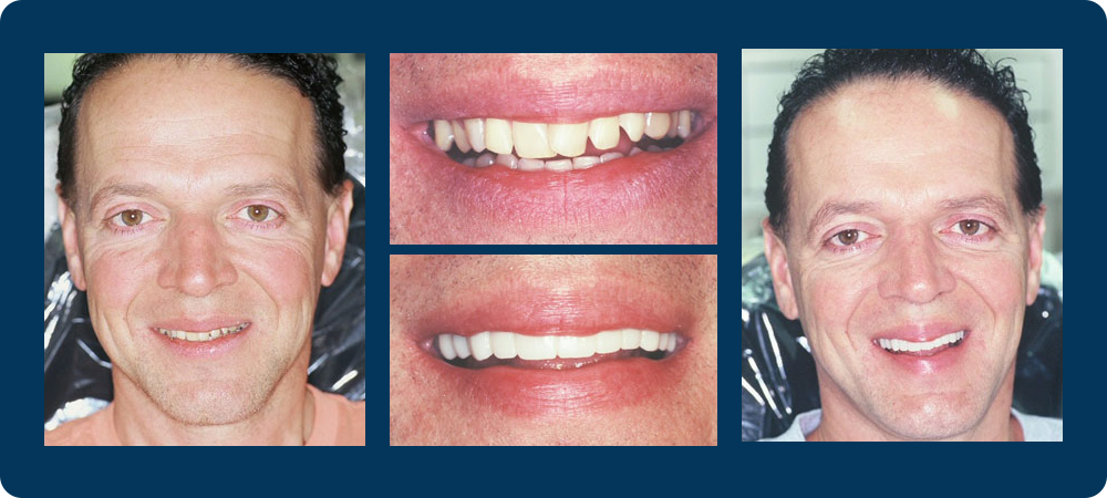 4 before and afters pictures of a male patient of Dr. Koutsioukis