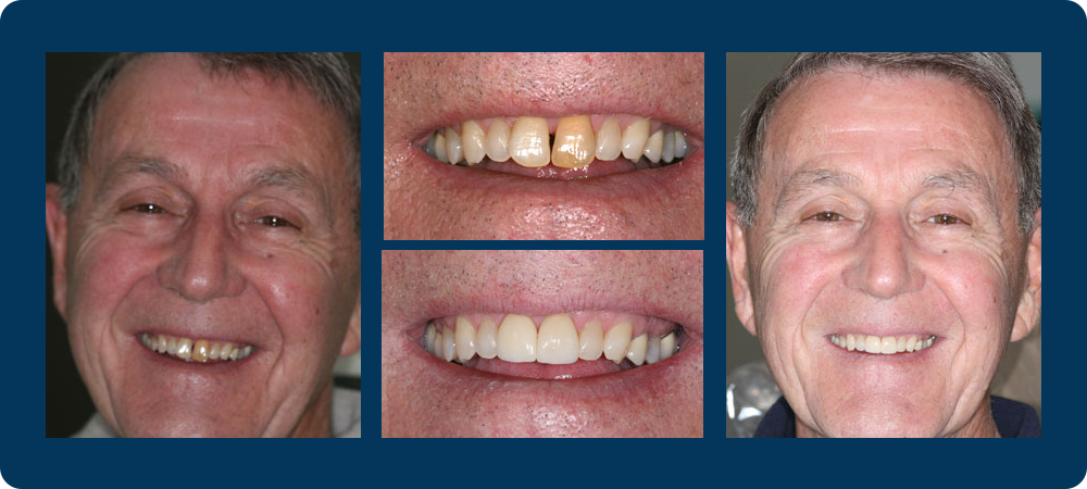 Smile Gallery - 4 before and afters pictures of a male patient of Dr. Koutsioukis