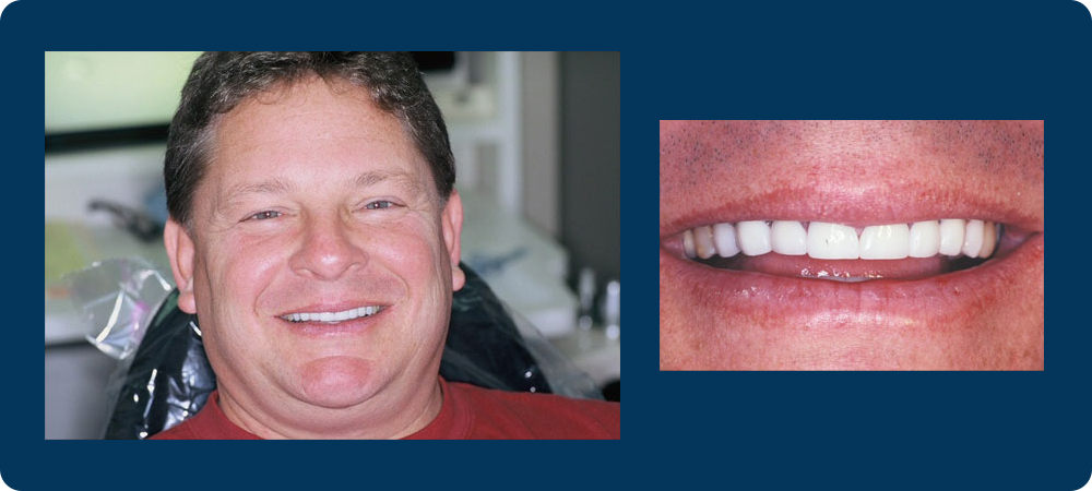 Smile Gallery - 2 pictures of a male patient of Dr. Koutsioukis, one of a close up of his teeth