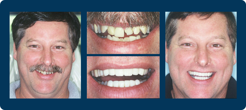 Smile Gallery - 4 before and afters pictures of a male patient of Dr. Koutsioukis