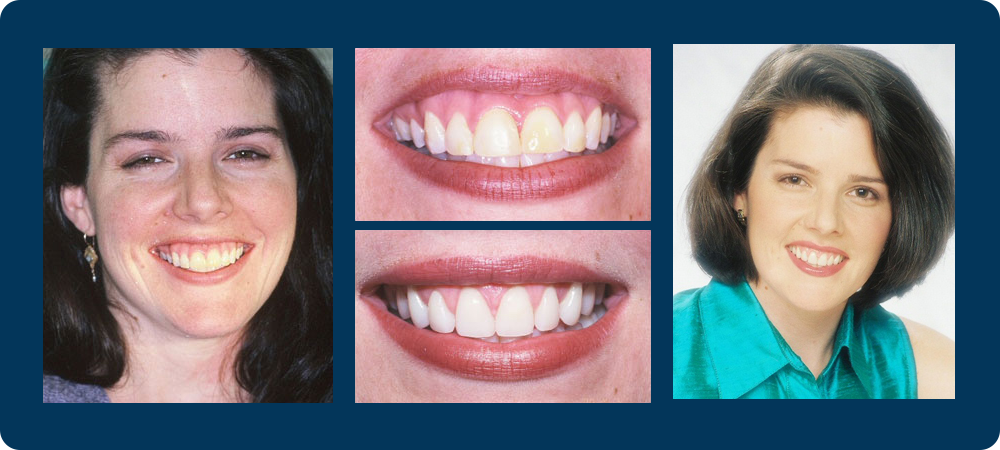 Smile Gallery - 4 before and afters pictures of a female patient of Dr. Koutsioukis