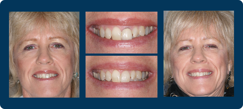 Smile Gallery - 4 before and afters pictures of a female patient of Dr. Koutsioukis