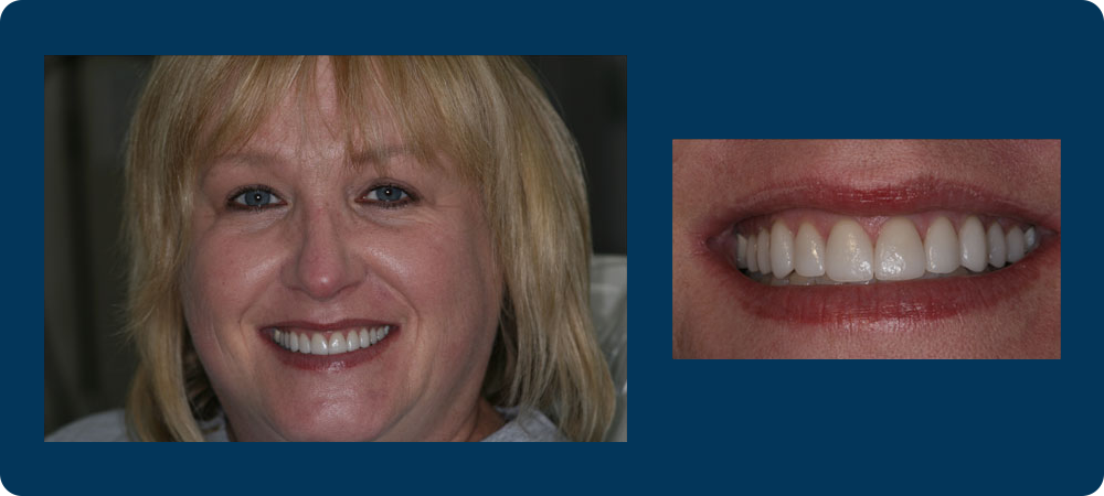 Smile Gallery - 2 pictures of a female patient of Dr. Koutsioukis, one of a closeup of her teeth