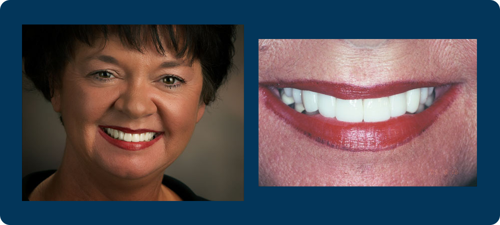 2 pictures of a female patient of Dr. Koutsioukis, one of a close up of her teeth