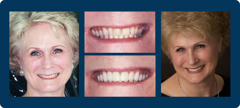 4 before and afters pictures of a female patient of Dr. Koutsioukis