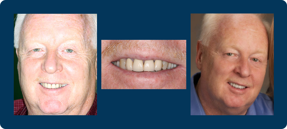 3 before and afters pictures of a male patient of Dr. Koutsioukis